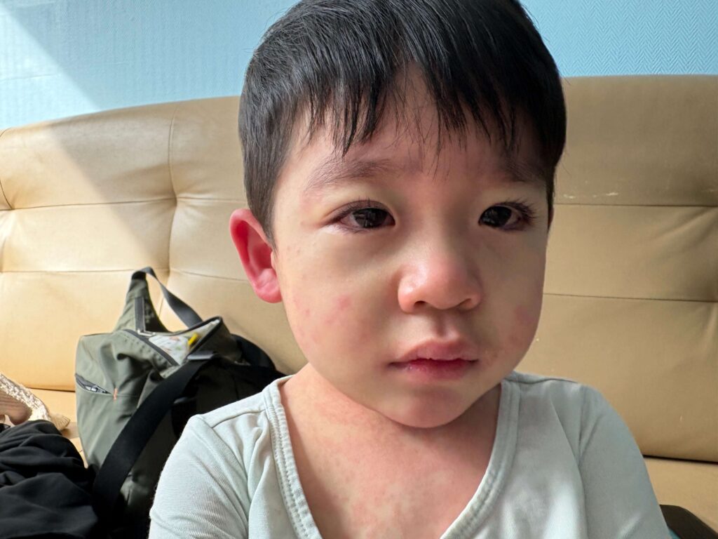 가와사키증상