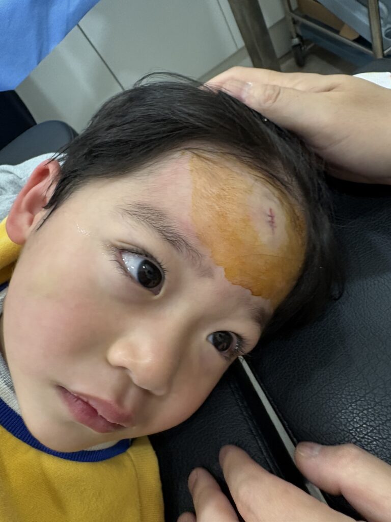 30개월 아이 이마 찢어짐 봉합 후기